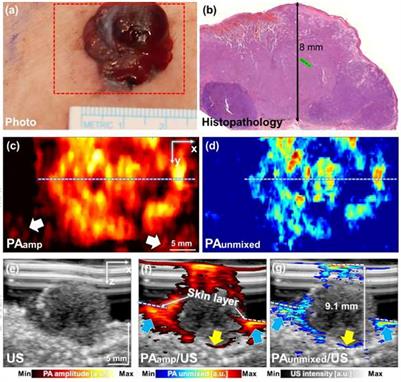 Clinical photoacoustic/ultrasound dual-modal imaging: Current status and future trends